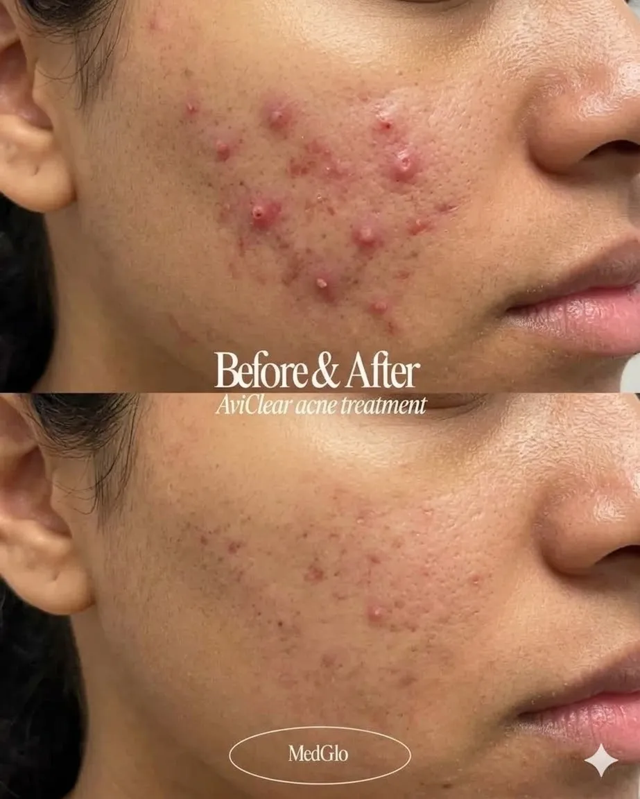 AviClear acne treatment before and after — real patient of Dr. Recalde at MedGlo, Mission Viejo CA