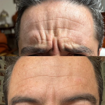 Botox líneas de expresión — MedGlo