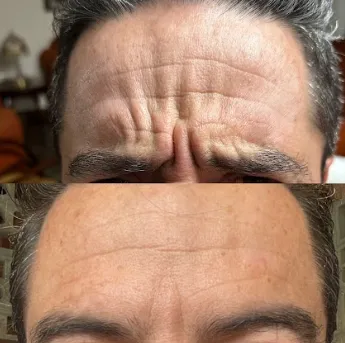 Botox líneas de expresión antes y después — MedGlo, Mission Viejo