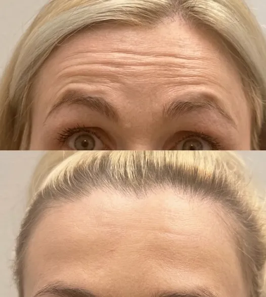 Botox frente antes y después — MedGlo, Mission Viejo