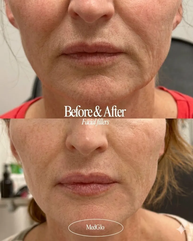 Facial fillers before and after — real patient of Dr. Recalde at MedGlo, Mission Viejo CA