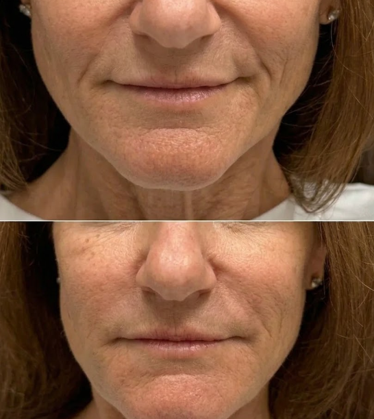 Rellenos faciales — MedGlo