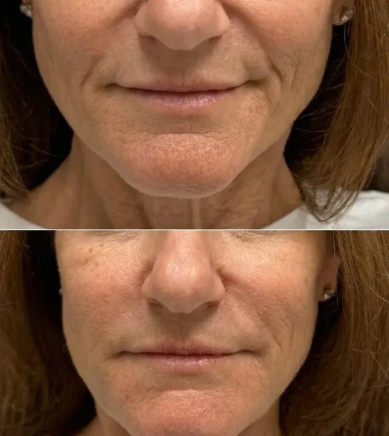 Rellenos faciales antes y después — MedGlo, Mission Viejo