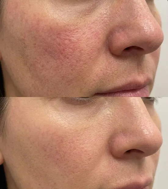 Laser Genesis before and after — real patient of Dr. Recalde at MedGlo, Mission Viejo CA