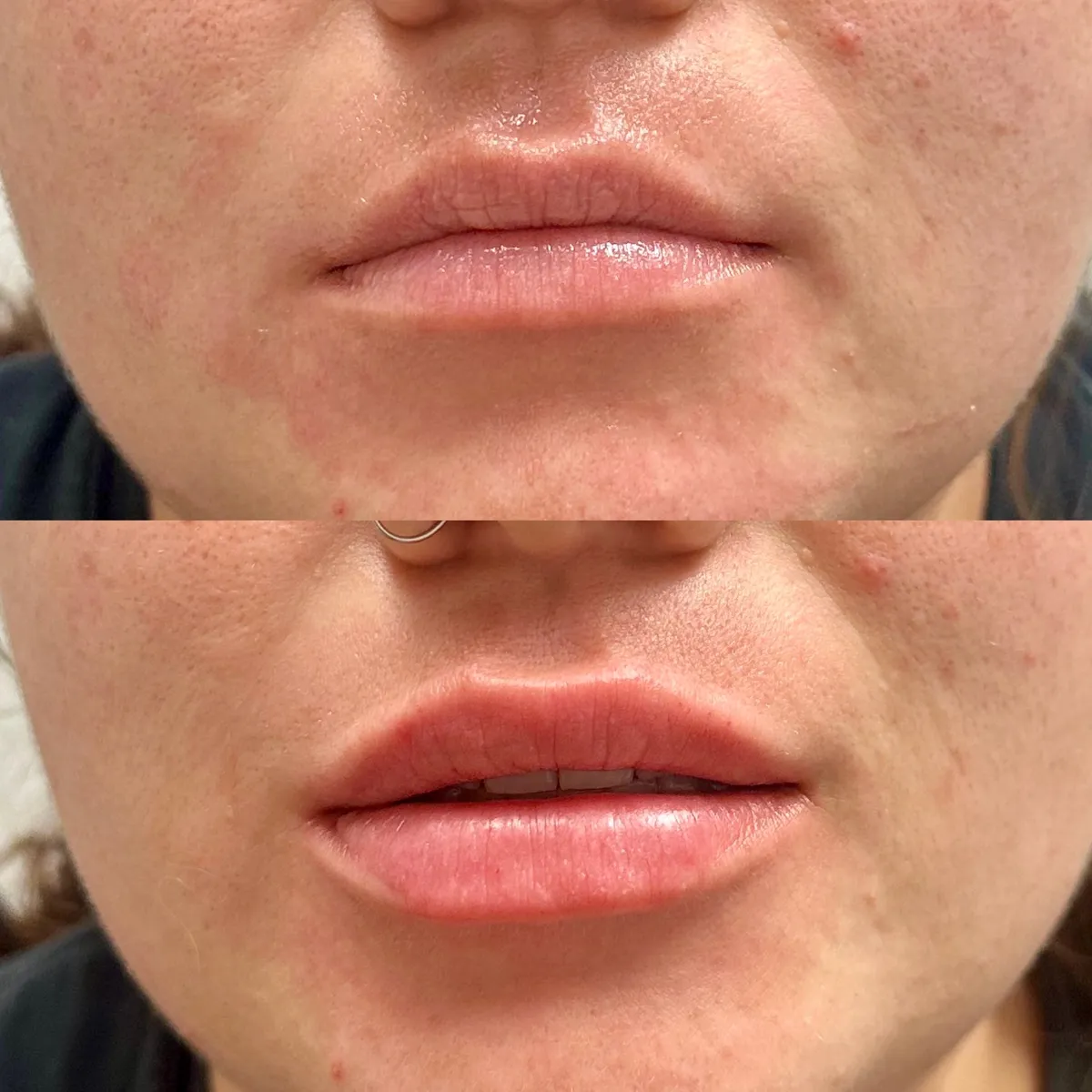Relleno labial antes y después — MedGlo, Mission Viejo