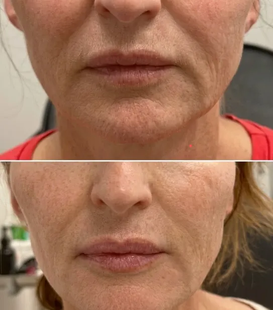 Lip fillers before and after — real patient of Dr. Recalde at MedGlo, Mission Viejo CA