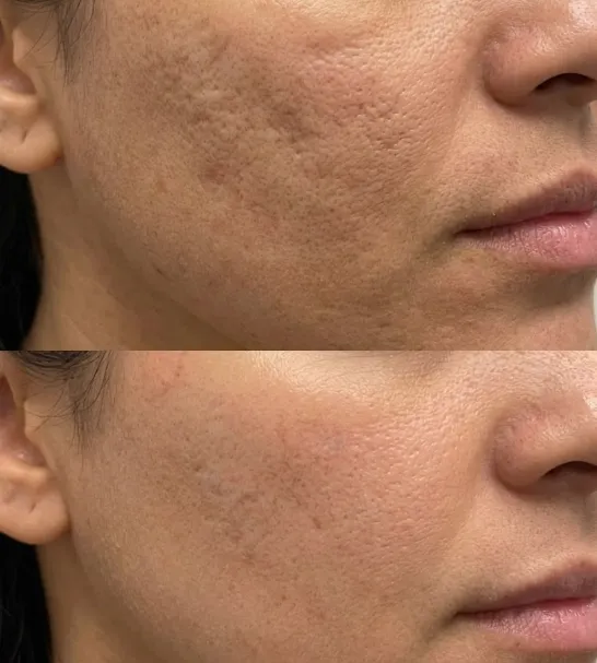Microneedling before and after — real patient of Dr. Recalde at MedGlo, Mission Viejo CA