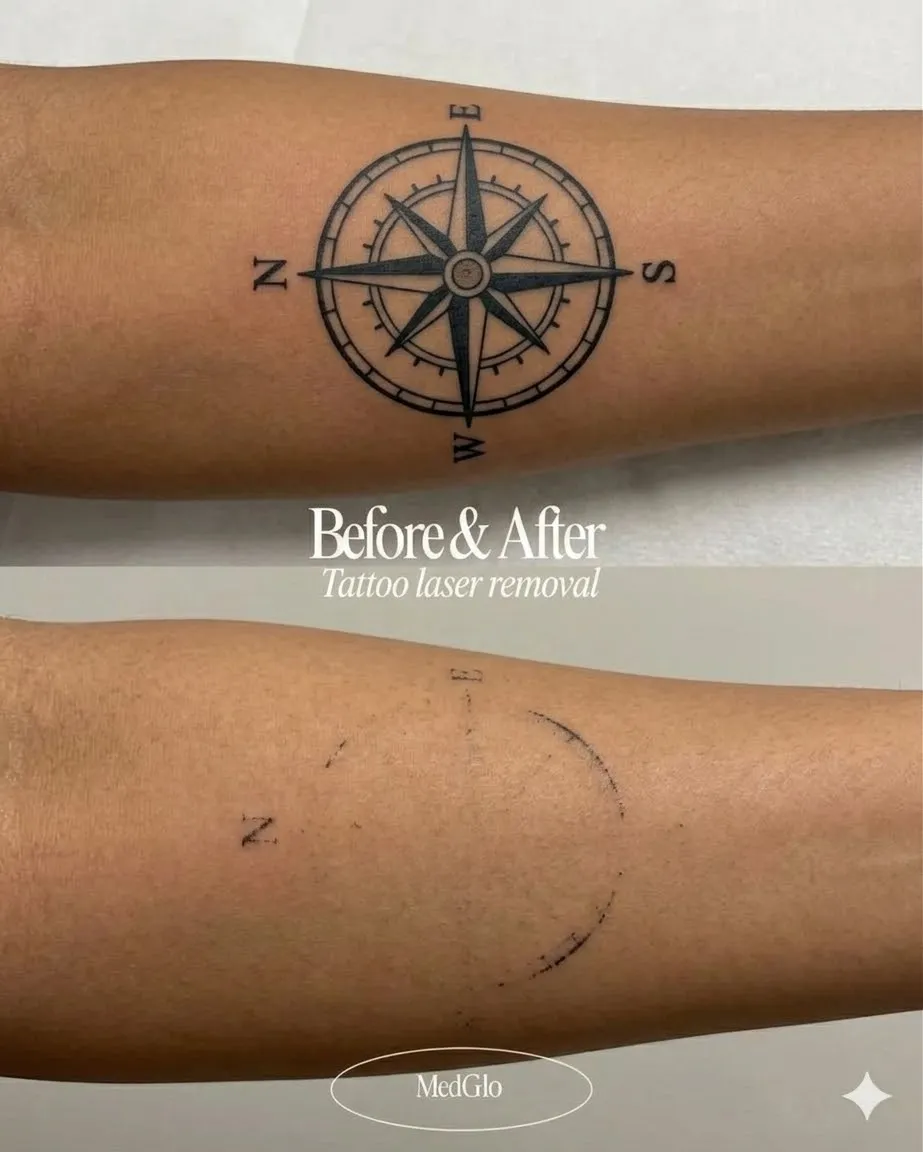 Laser tattoo removal before and after — real patient of Dr. Recalde at MedGlo, Mission Viejo CA