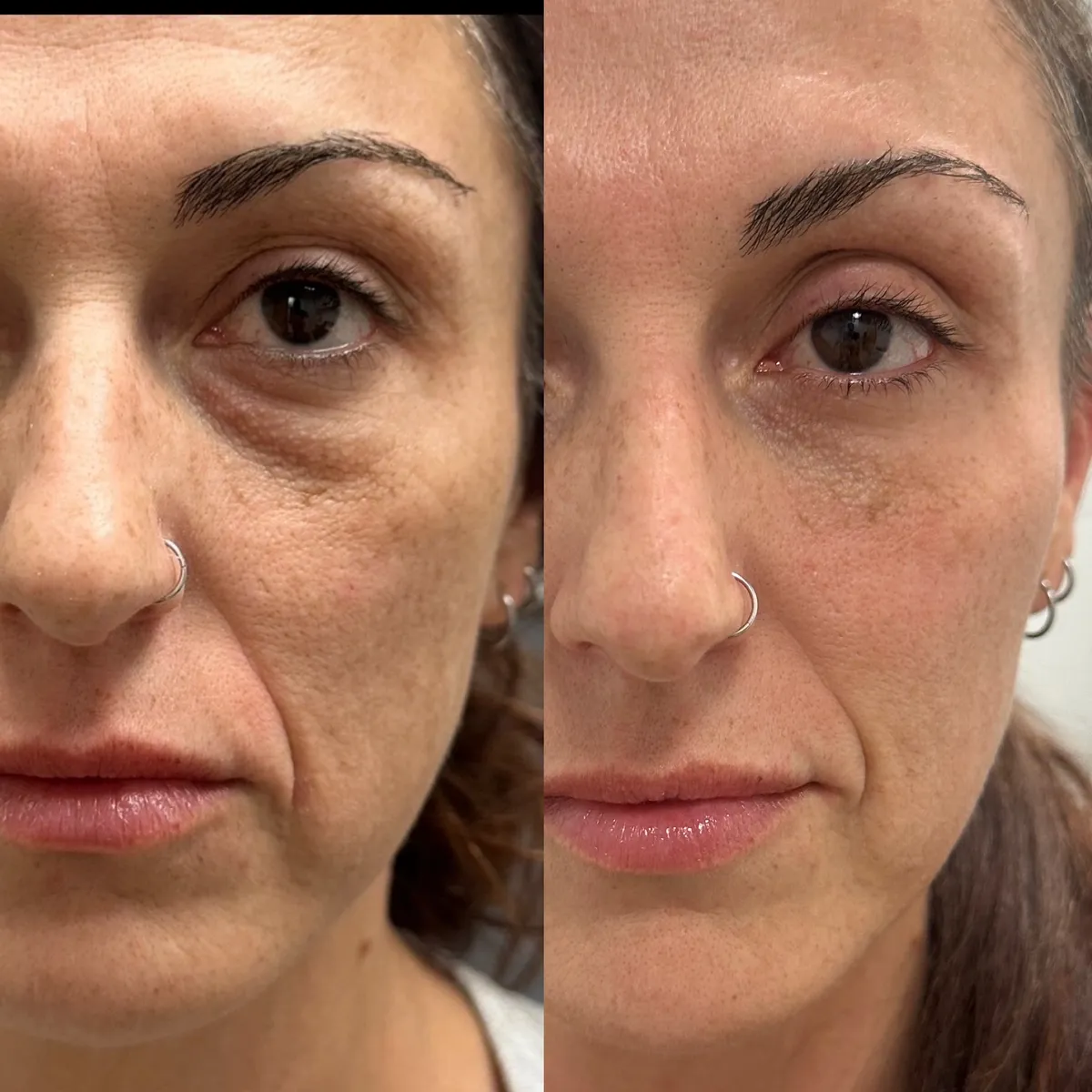 Under-eye fillers B&A — MedGlo