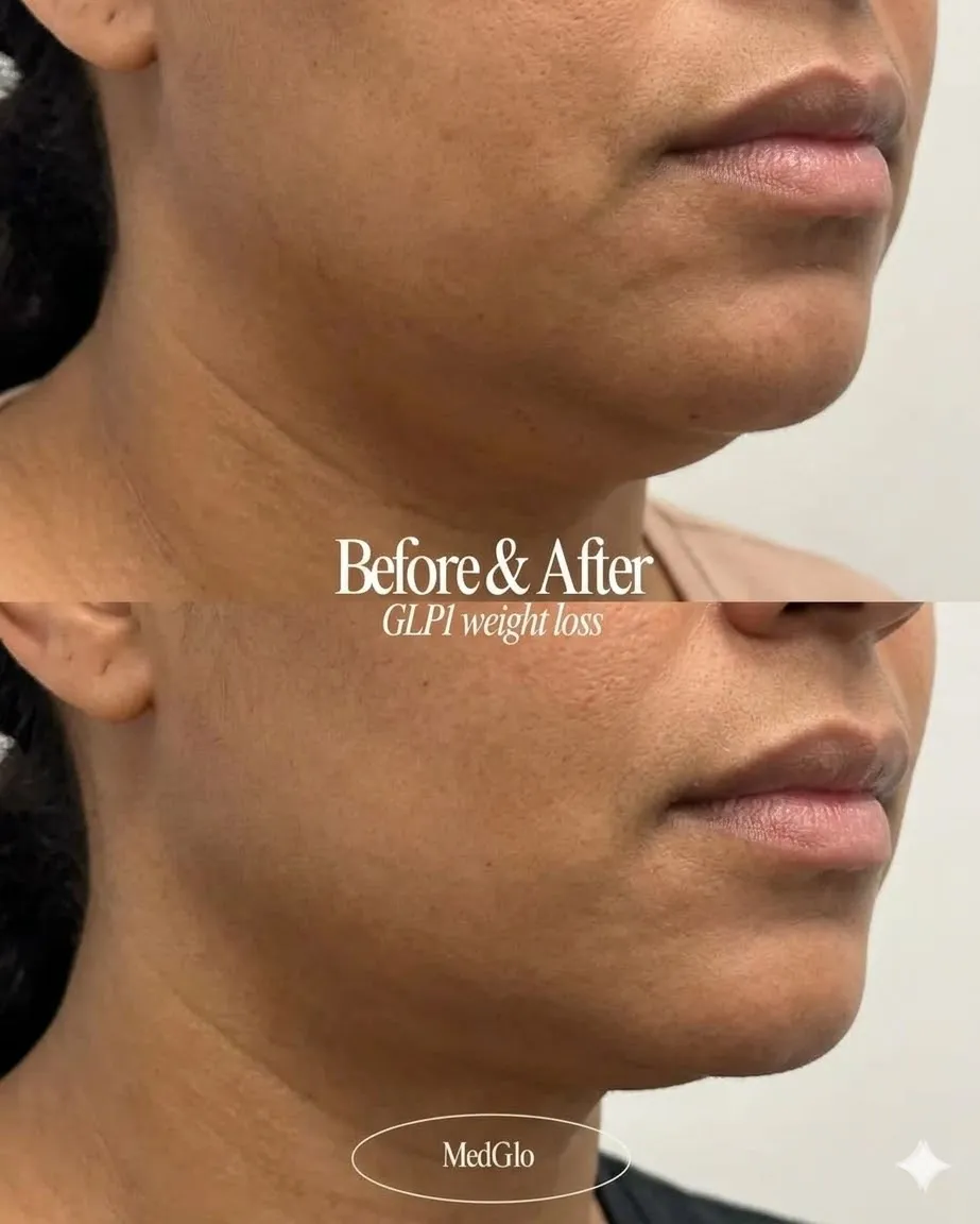 GLP-1 medical weight loss before and after — real patient of Dr. Recalde at MedGlo, Mission Viejo CA