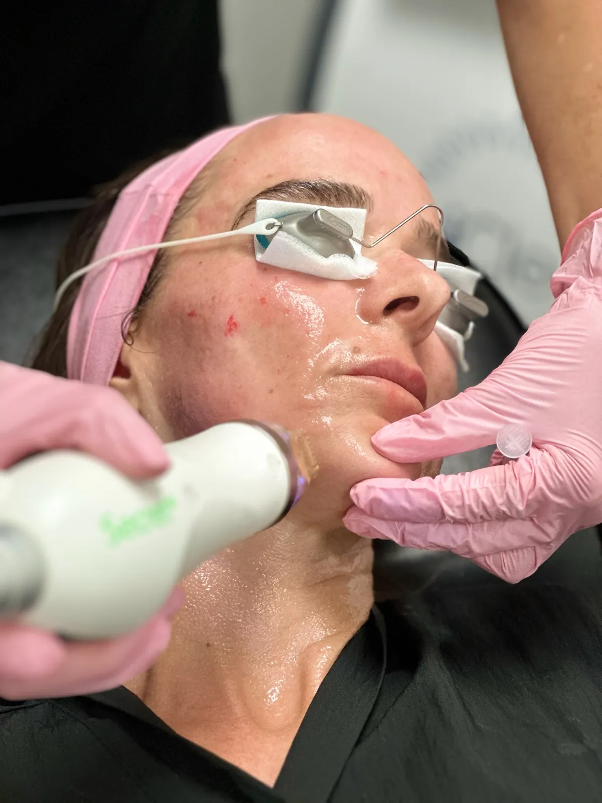 Tratamiento láser facial — MedGlo, Mission Viejo