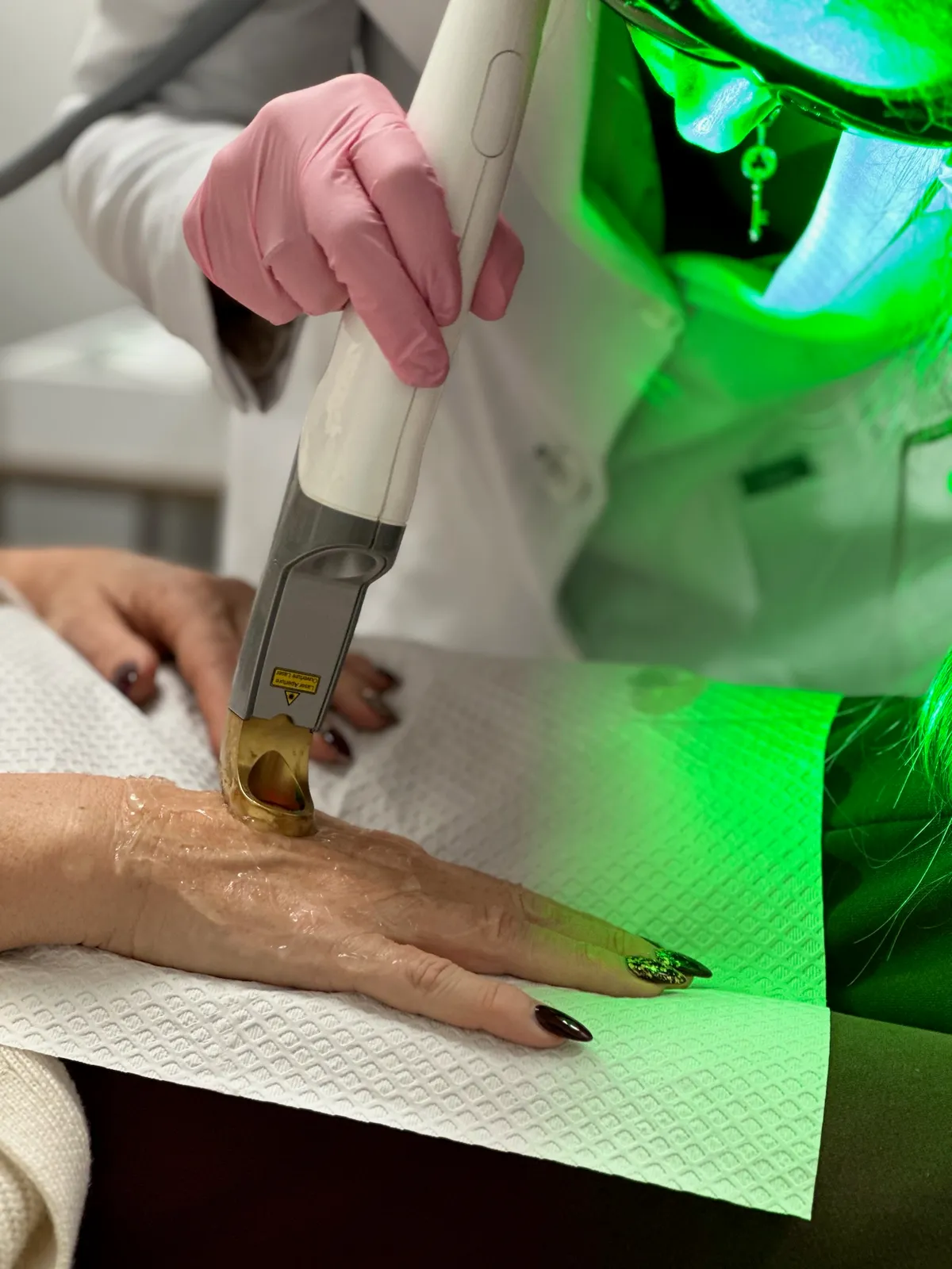 Tratamiento láser en mano — MedGlo, Mission Viejo